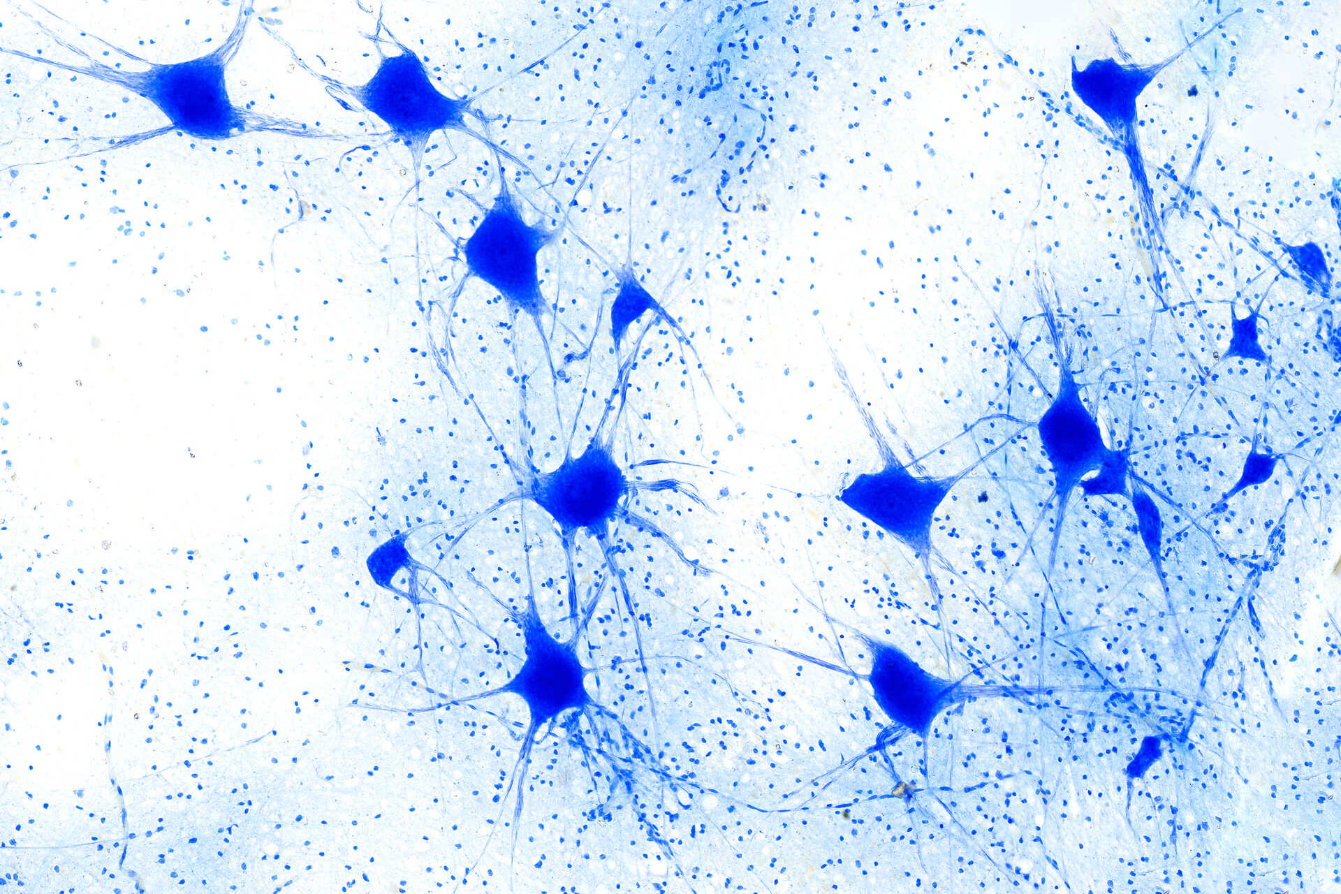 Neurodegenerazione (1)